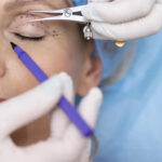 Cirurgia Blefaroplastia