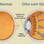 Cirurgia Glaucoma