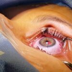 Cirurgia Refrativa